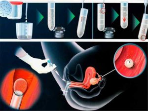 Figura demonstrativa IIU: etapas do processo de preparo seminal e colocação dos espermatozoides capacitados no útero