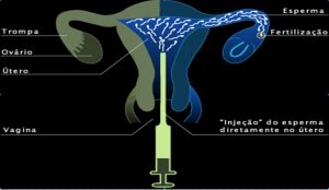 Figura 1: Figura demonstrativa Inseminação Intrauterina Heteróloga – Colocação dos espermatozóides do doador capacitados no útero, no dia da ovulação
