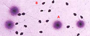 Fragmentação DNA: A: espermatozoides sem fragmentação; B: espermatozoides com fragmentação DNA