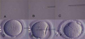Técnica de ICSI: A,B e C – captura e imobilização do espermatozoide; D, E e F – injeção do espermatozoide no oócito